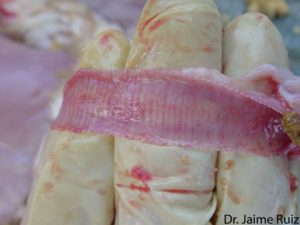 Hemorrhage & Edema in trachea