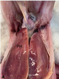 Perihepatitis with a fibrinous perihepatitis