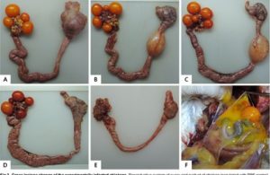 (INOCULATIN EDS127 VIRUS in chicken) (E). Ruptured ovarian follicles (F) peritonitis 