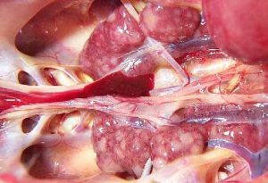 ایجاد تومور در کلیه ها (Marek's_Disease-kidney-tumor)