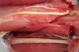 بزرگ شدگی اعصاب سیاتیک (Sciatic-Nerves-Normal&affected)